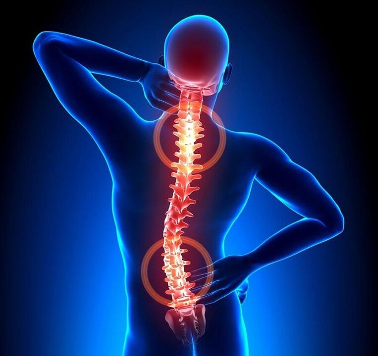 sırt ağrısının bir nedeni olarak omurganın osteokondrozu