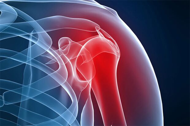 osteoartrit nedeniyle omuz ağrısı