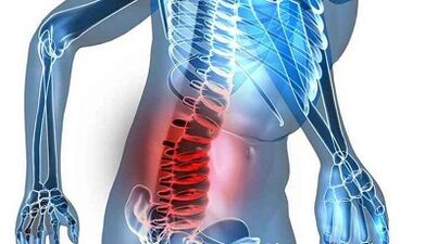 Lomber osteokondrozun belirtileri ve semptomları